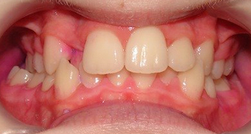 Before Before