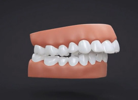 Removal of Four 1st Premolars to Reduce Lip Fullness