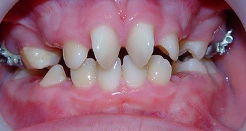 Before Before
