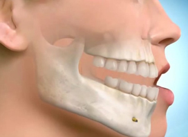 Lower Jaw Set-Back Surgery