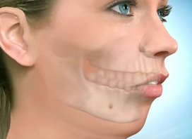 Lower Jaw Advancement Surgery