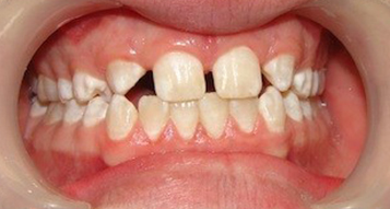 Before Before