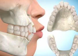 Removal of Four 1st Premolars to Reduce Lip Fullness