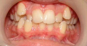 Before Before