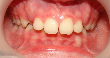 Before Before